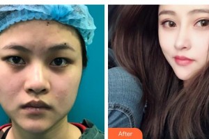 郯城新益民眼科醫(yī)院趙陽(yáng)整形價(jià)格表附切開雙眼皮案例展示