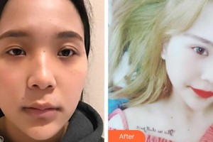 郯城新益民眼科醫(yī)院李光達(dá)整形價(jià)格表附切開雙眼皮案例展示