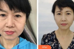 郯城縣第一人民醫(yī)院眼科孫虹整形價(jià)格表附外切祛眼袋案例展示