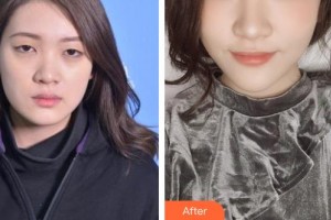 郯城新益民眼科醫(yī)院解孝峰整形價(jià)格表附切開雙眼皮案例展示