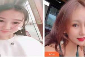 郯城新益民眼科醫(yī)院冷非整形價(jià)格表附切開雙眼皮案例展示