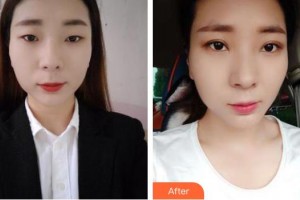 邯鄲京美整形醫(yī)院張丙海整形價(jià)格表附眼部綜合案例展示