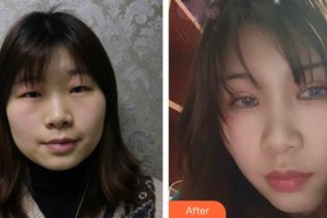 邯鄲京美整形醫(yī)院張煒整形價(jià)格表附眼部綜合案例展示