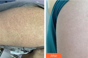 邯鄲市第七醫(yī)院整形科趙瑞艷整形價(jià)格表附清潔祛痘案例展示