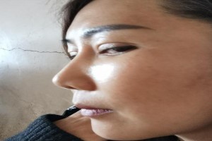 韓國(guó)一見(jiàn)Izien整形外科醫(yī)院金一秀輪廓修復(fù)整形果分享