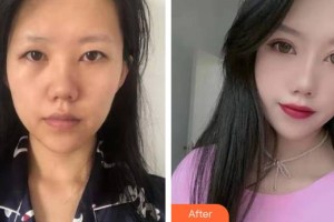 邯鄲金皇后醫(yī)療美容診所王紅莉整形價格表附眼部綜合案例展示