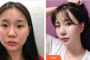 邯鄲市眼科醫(yī)院范肅潔整形價格表附眼部綜合案例展示