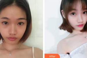 邯鄲市眼科醫(yī)院王玉萍整形價(jià)格表附定點(diǎn)雙眼皮案例展示