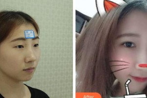 邯鄲市眼科醫(yī)院雷秀麗整形價(jià)格表附眼部修復(fù)案例展示