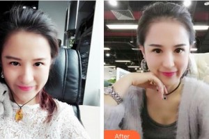 邯鄲市眼科醫(yī)院韋敏整形價(jià)格表附埋線雙眼皮案例展示