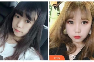 邯鄲市眼科醫(yī)院李梅霞整形價(jià)格表附切開(kāi)雙眼皮案例展示