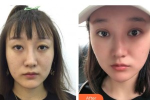 邯鄲市眼科醫(yī)院郭風(fēng)英整形價(jià)格表附眼部整形案例展示