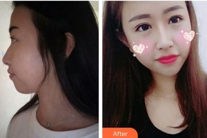 邯鄲市眼科醫(yī)院王海龍整形價(jià)格表附眼部綜合案例展示