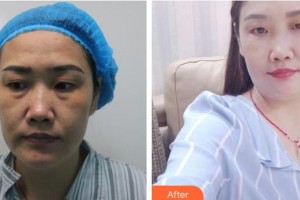 邯鄲市眼科醫(yī)院張紅霞整形價(jià)格表附外切祛眼袋案例展示