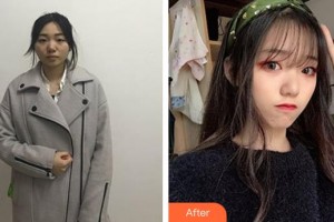 邯鄲市眼科醫(yī)院張亞娟整形價(jià)格表附切開雙眼皮案例展示