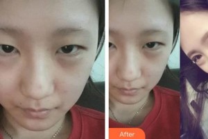 邯鄲愛眼眼科醫(yī)院郝俊華整形價(jià)格表附切開雙眼皮案例展示