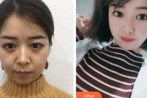 邯鄲愛眼眼科醫(yī)院高占國整形價(jià)格表附切開雙眼皮案例展示