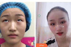 邯鄲愛(ài)爾眼科醫(yī)院孫蘭萍院長(zhǎng)整形價(jià)格表附切開(kāi)雙眼皮案例展示