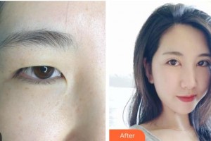 邯鄲愛(ài)爾眼科醫(yī)院龐愛(ài)蓮整形價(jià)格表附激光去眼袋案例展示