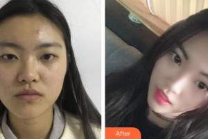 邯鄲京美整形醫(yī)院張芳輝整形價(jià)格表附切開(kāi)雙眼皮案例展示