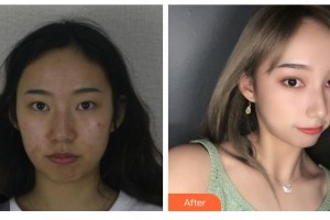 邯鄲愛(ài)爾眼科醫(yī)院王炳亮整形價(jià)格表附眼部綜合案例展示