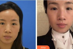 邯鄲愛(ài)爾眼科醫(yī)院申育華整形價(jià)格表附切開(kāi)雙眼皮案例展示