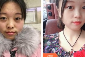 邯鄲貝潔口腔醫(yī)院滿玉娥整形價(jià)格表附金屬托槽矯正案例展示