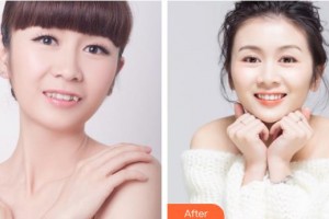 邯鄲貝潔口腔醫(yī)院張利衡整形價(jià)格表附牙齒矯正案例展示