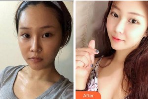 漢口愛爾眼科醫(yī)院曾慶延整形價(jià)格表附眼部綜合案例展示