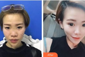 漢口愛爾眼科醫(yī)院許榮整形價(jià)格表附眼部綜合案例展示