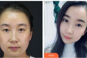 漢口愛爾眼科醫(yī)院諶丹整形價(jià)格表附眼部綜合案例展示