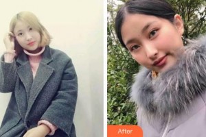 漢口愛爾眼科醫(yī)院呂露整形價(jià)格表附切開雙眼皮案例展示