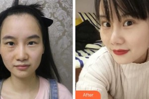 漢口愛爾眼科醫(yī)院陳英整形價(jià)格表附眼部綜合案例展示