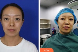 漢口愛爾眼科醫(yī)院羅恒清整形價(jià)格表附外切祛眼袋案例展示