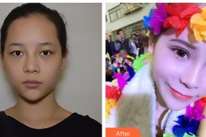 漢口愛爾眼科醫(yī)院陳華整形價(jià)格表附切開雙眼皮案例展示