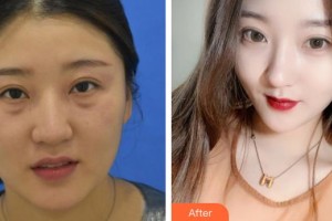 漢口愛爾眼科醫(yī)院張詠整形價格表附眼部修復(fù)案例展示