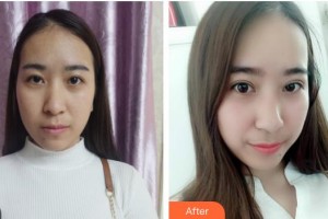 漢口愛爾眼科醫(yī)院劉俊杰整形價(jià)格表附埋線雙眼皮案例展示