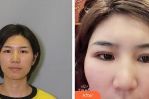 漢口愛爾眼科醫(yī)院劉麗芳整形價格表附切開雙眼皮案例展示