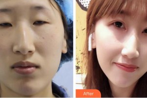 湘西麗人整形美容醫(yī)院彭勁松整形價格表附切開雙眼皮案例展示