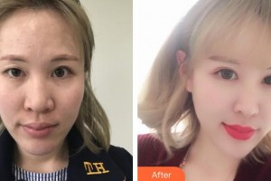 湘西愛爾眼科醫(yī)院馮菊芝整形價格表附切開雙眼皮案例展示