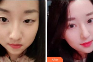 湘西愛爾眼科醫(yī)院田勇輝整形價格表附切開雙眼皮案例展示