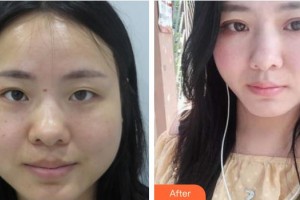 汕頭國際眼科中心陳偉奇整形價格表附眼部整形案例展示