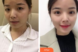 深圳市眼科醫(yī)院陳璐整形價格表附切開雙眼皮案例展示