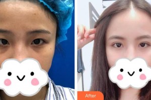 深圳德視佳眼科門診部鐘瀟健住院醫(yī)師整形價格表附眼部綜合案例展示