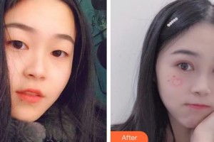 深圳市眼科醫(yī)院曾琨整形價格表附眼部綜合案例展示