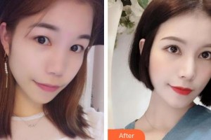 深圳華夏眼科醫(yī)院趙鐵英整形價格表附內切祛眼袋案例展示