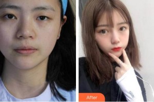 深圳市眼科醫(yī)院胡憶群整形價格表附切開雙眼皮案例展示