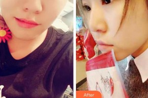 深圳市眼科醫(yī)院張國明整形價格表附切開雙眼皮案例展示