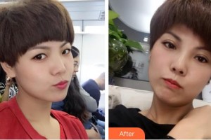 深圳市眼科醫(yī)院佘潔婷整形價格表附眼部修復案例展示