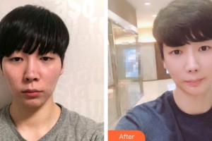 深圳愛爾眼科醫(yī)院林晨整形價格表附眼部修復案例展示